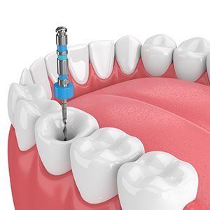 Root Canal Treatment in Guntur